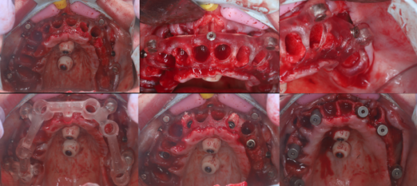 Advanced Guided Surgery Course - January 2025 - Image 2